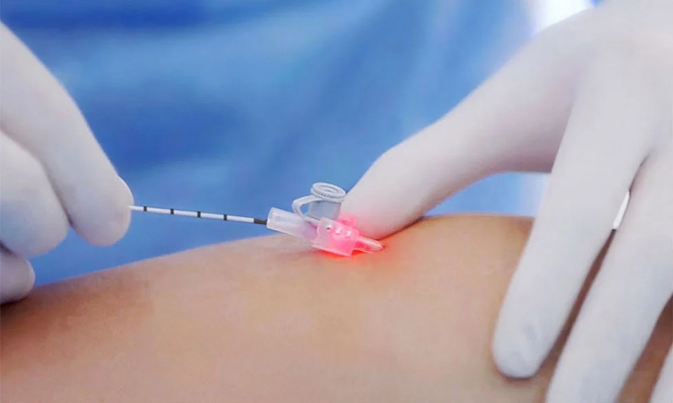 imgi_25_Endovenous-Laser-Treatment-02